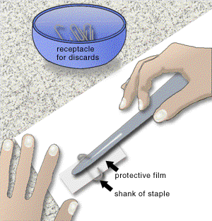 Basic remedial treatment - Paper materials: Metal fasteners with protective film